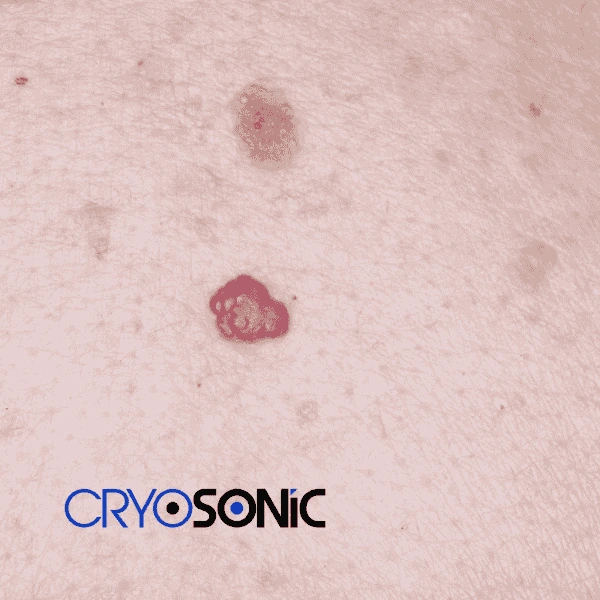 Looking for pain free cherry angioma removal treatment Chesterfield? Call our team today! Chesterfield