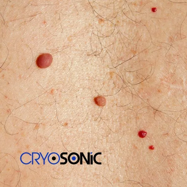 get cherry angioma removal treatment today! Chesterfield