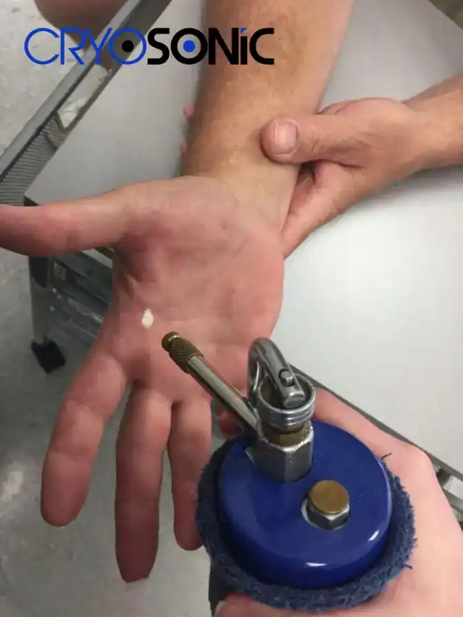 Temperature Differences: OTC vs Medical-Grade Cryotherapy Chesterfield